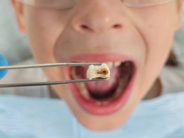 Best Urgent Care for Lost Fillings or Crowns in El Jon, CA